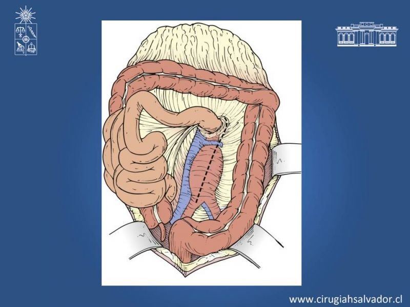 Diapositiva 45 de Lesiones Arteriales de Aorta abdominal e Iliacas 