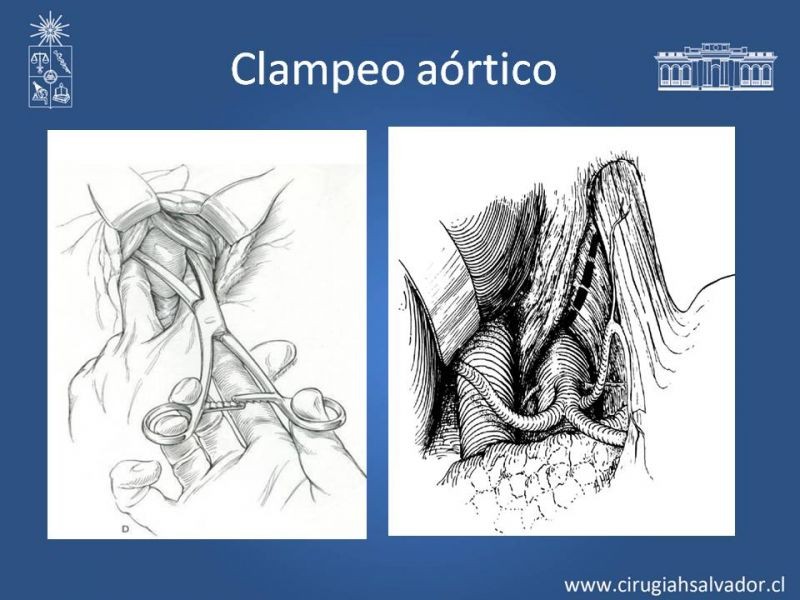 Diapositiva 31 de Lesiones Arteriales de Aorta abdominal e Iliacas 
