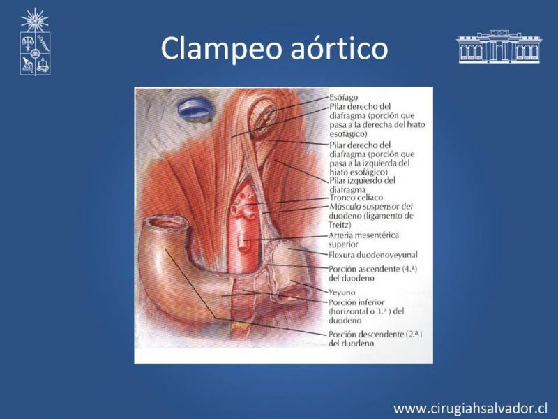 Diapositiva 30 de Lesiones Arteriales de Aorta abdominal e Iliacas 