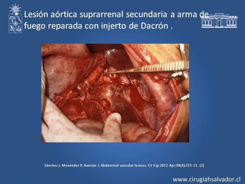 Diapositiva 35 de Lesiones Arteriales de Aorta abdominal e Iliacas 