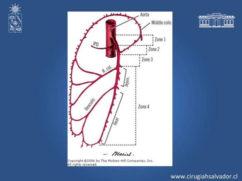 Diapositiva 42 de Lesiones Arteriales de Aorta abdominal e Iliacas 