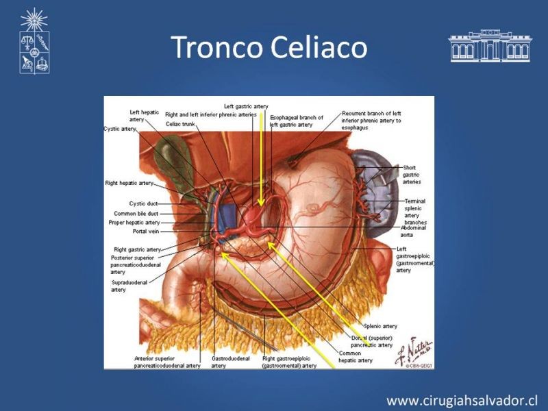 Diapositiva 38 de Lesiones Arteriales de Aorta abdominal e Iliacas 