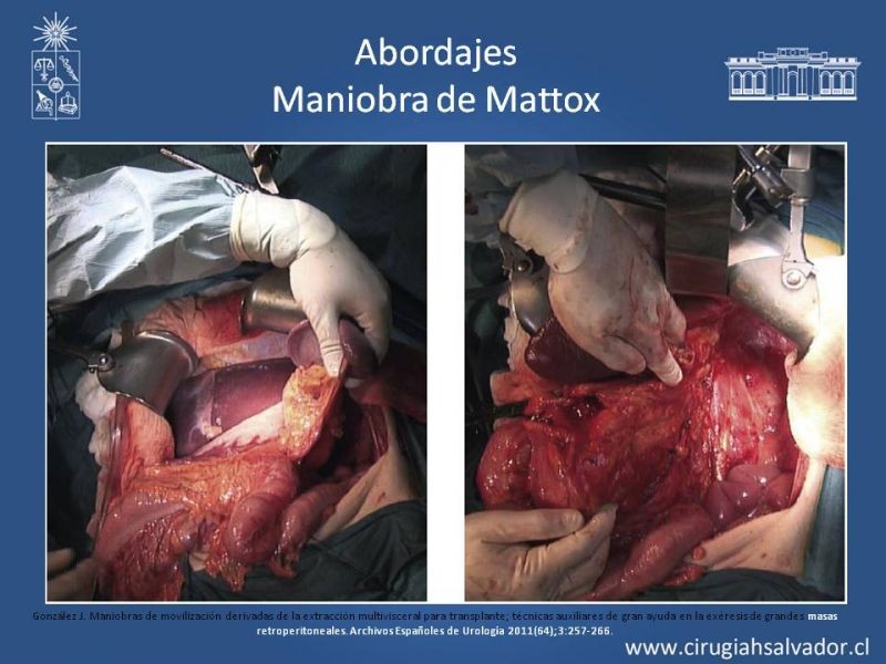 Diapositiva 28 de Lesiones Arteriales de Aorta abdominal e Iliacas 