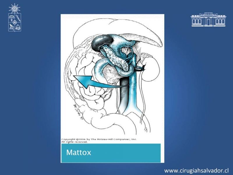 Diapositiva 27 de Lesiones Arteriales de Aorta abdominal e Iliacas 