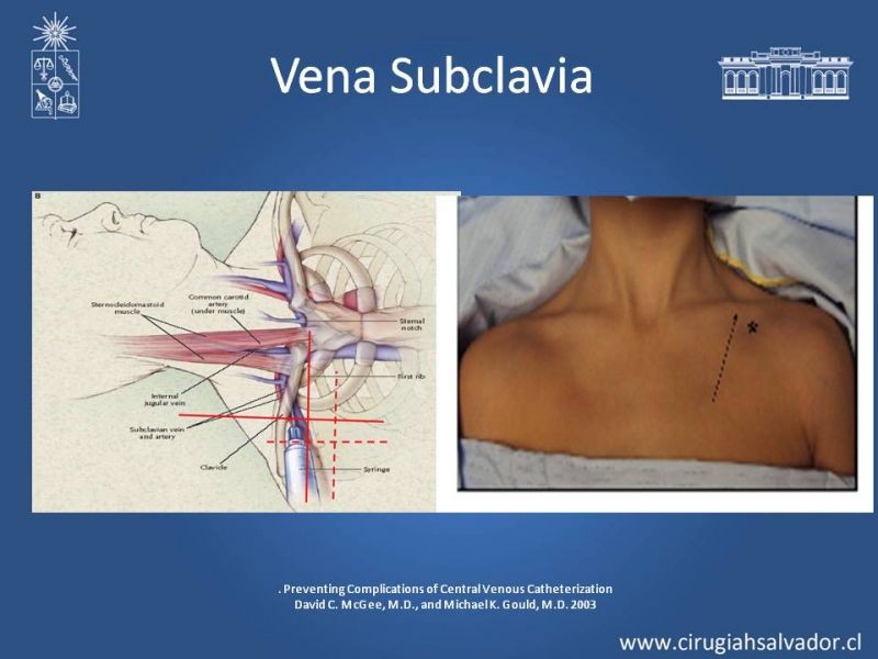 Diapositiva 9 de Accesos Vasculares Centrales