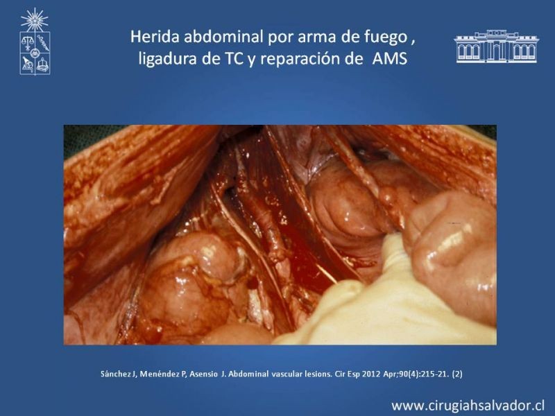 Diapositiva 40 de Lesiones Arteriales de Aorta abdominal e Iliacas 