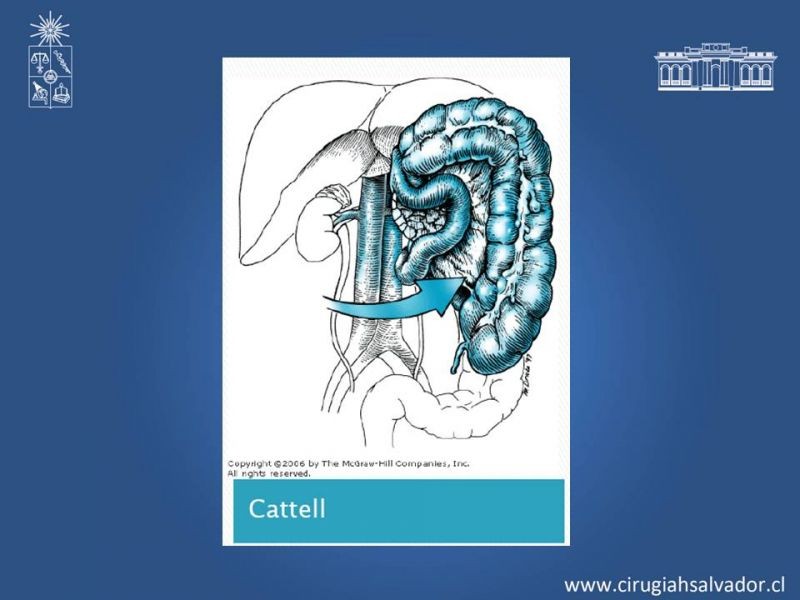 Diapositiva 49 de Lesiones Arteriales de Aorta abdominal e Iliacas 