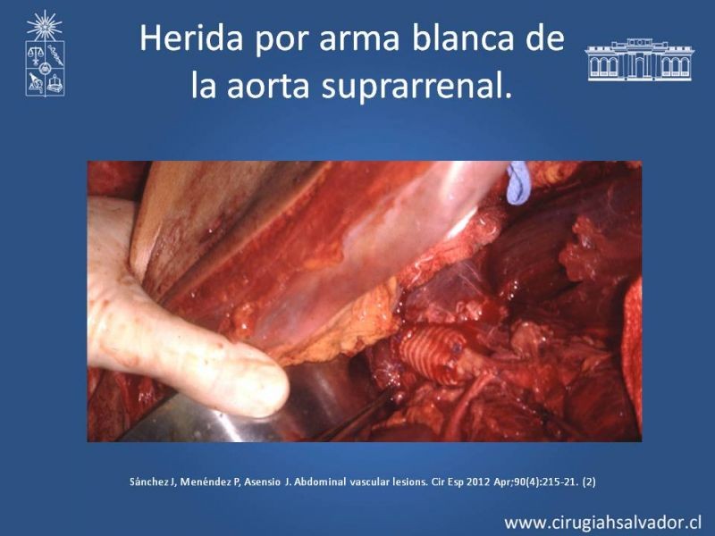Diapositiva 36 de Lesiones Arteriales de Aorta abdominal e Iliacas 