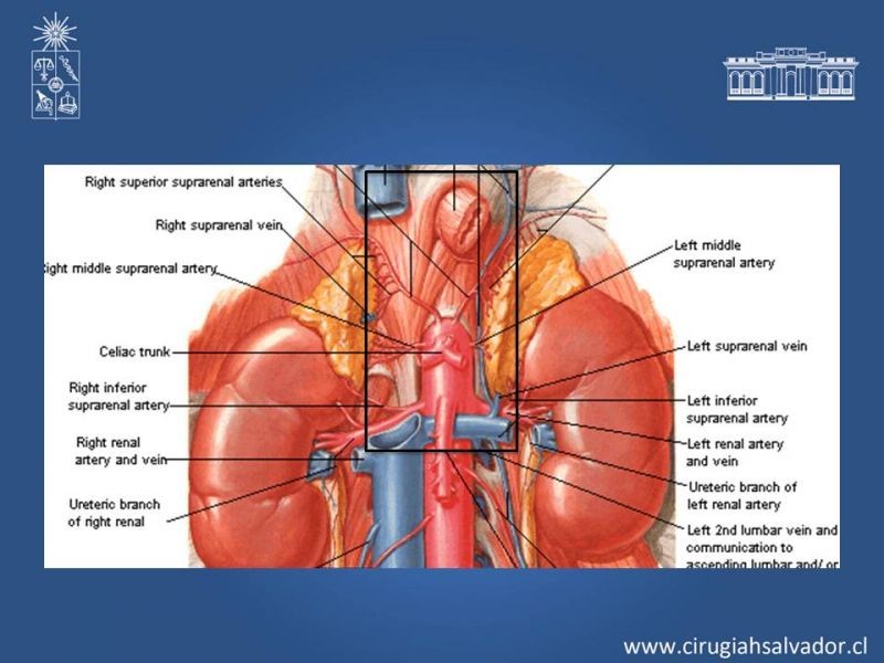Diapositiva 14 de Lesiones Arteriales de Aorta abdominal e Iliacas 