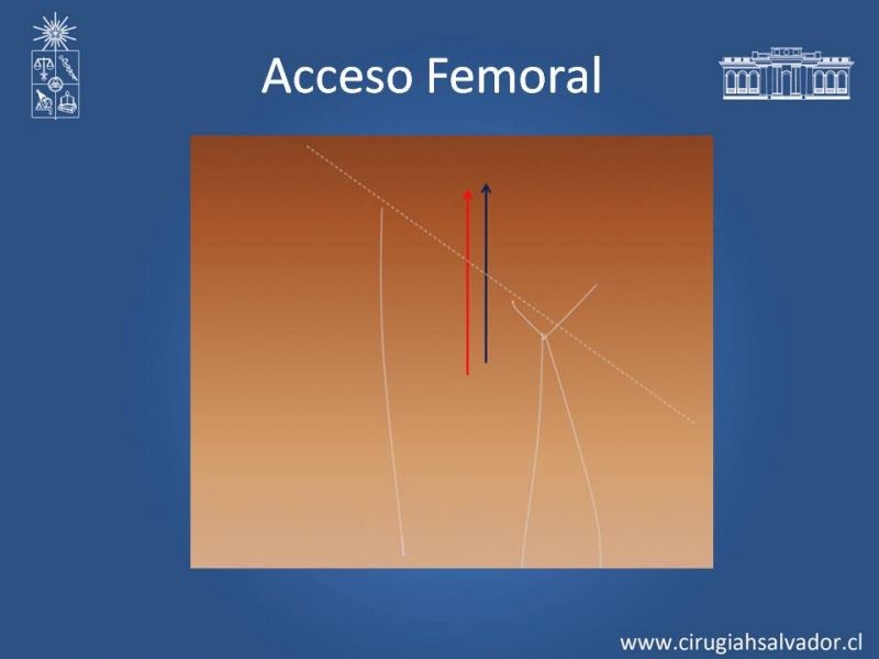Diapositiva 10 de Accesos Vasculares Centrales