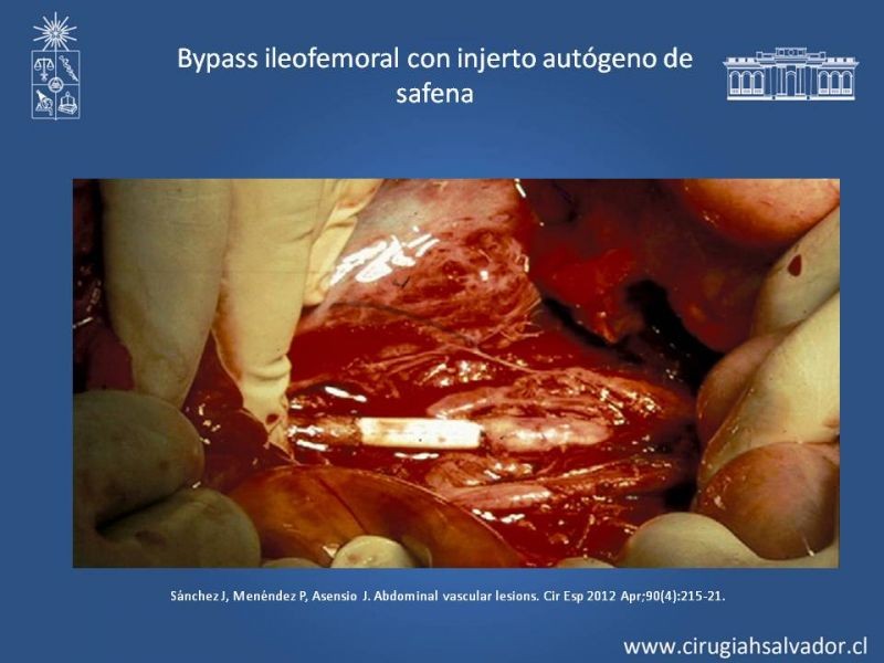 Diapositiva 55 de Lesiones Arteriales de Aorta abdominal e Iliacas 