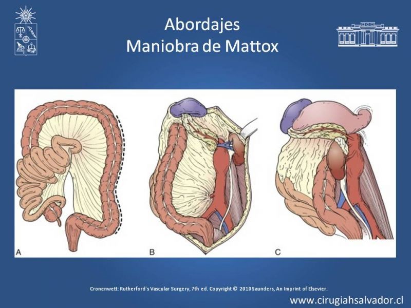 Diapositiva 29 de Lesiones Arteriales de Aorta abdominal e Iliacas 