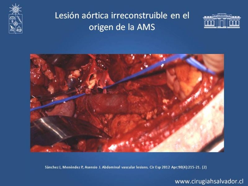 Diapositiva 37 de Lesiones Arteriales de Aorta abdominal e Iliacas 