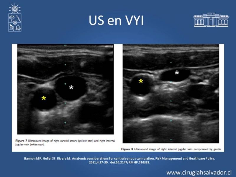 Diapositiva 6 de Accesos Vasculares Centrales