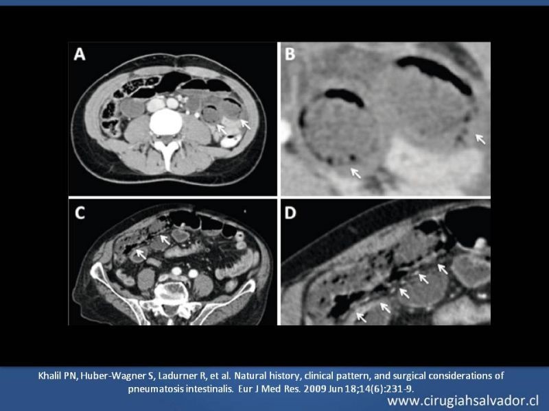 Diapositiva 19 de Neumatosis Intestinal