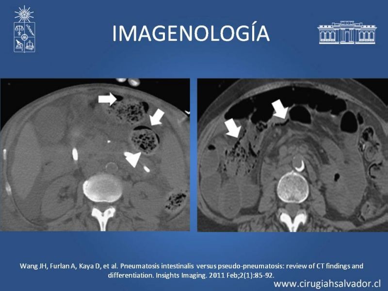 Diapositiva 7 de Neumatosis Intestinal