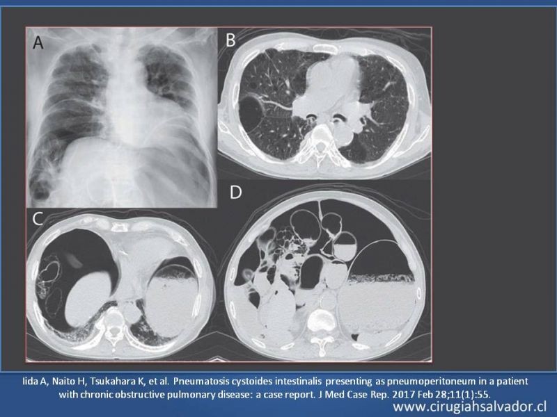 Diapositiva 31 de Neumatosis Intestinal