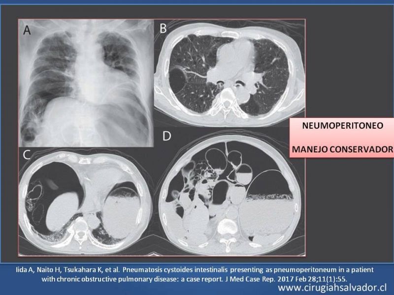 Diapositiva 32 de Neumatosis Intestinal