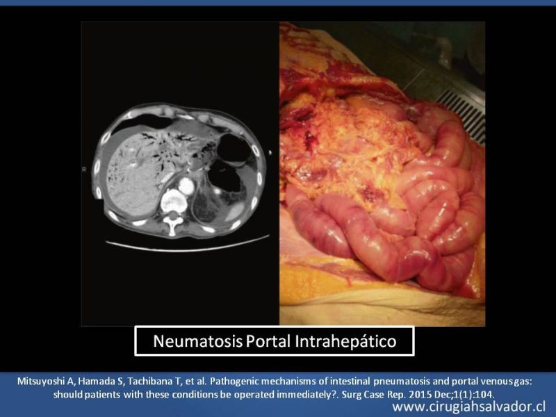 Diapositiva 21 de Neumatosis Intestinal