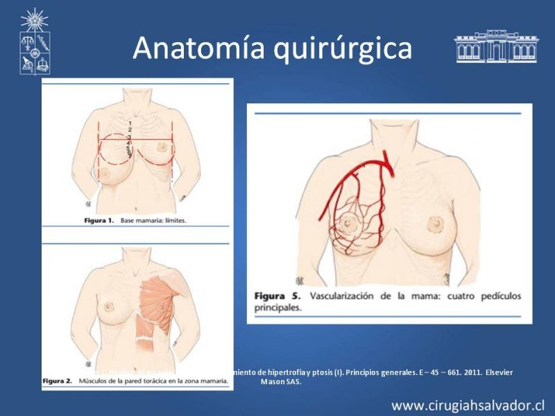 Diapositiva 2 de Reducción Mamaria