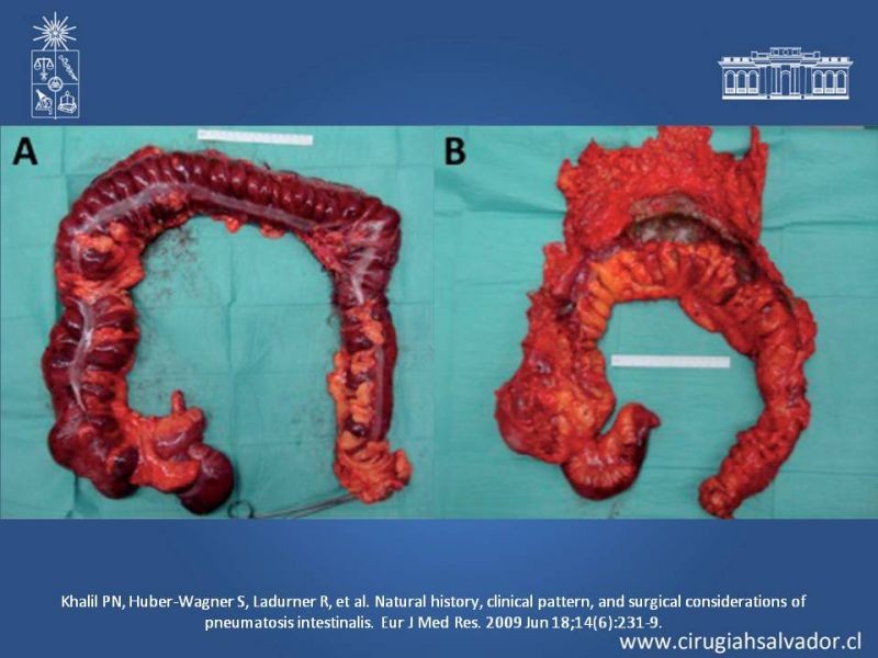 Diapositiva 24 de Neumatosis Intestinal