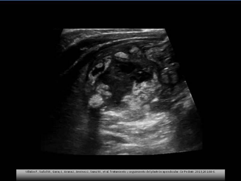 Diapositiva 3 de Manejo del plastron apendicular