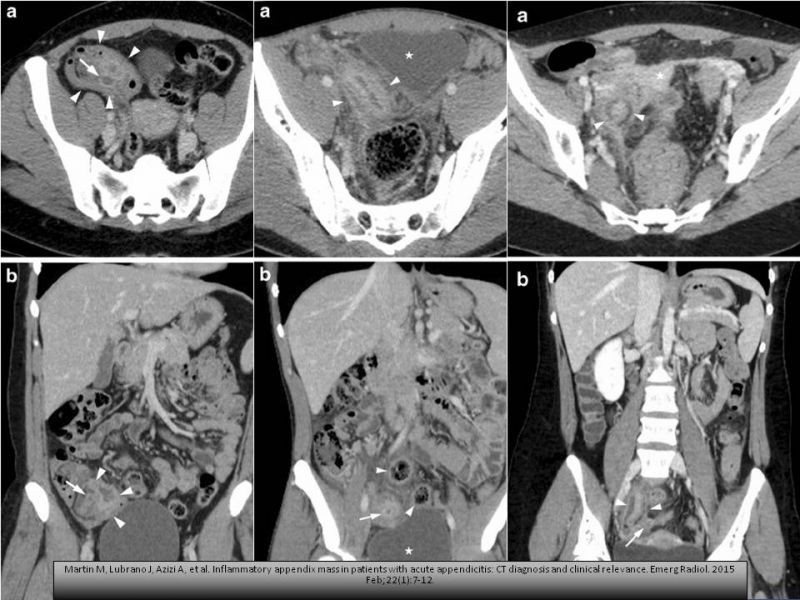 Diapositiva 2 de Manejo del plastron apendicular