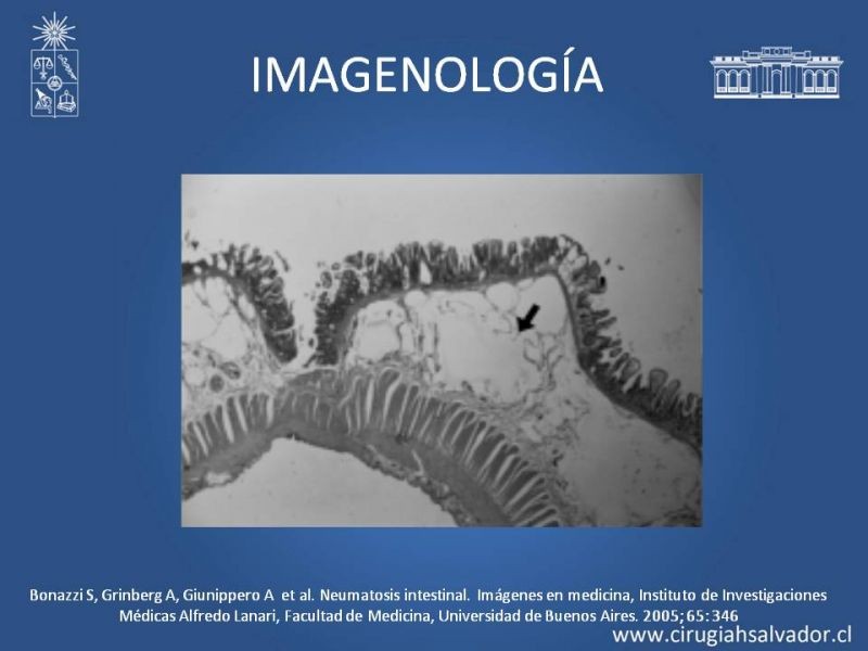 Diapositiva 6 de Neumatosis Intestinal