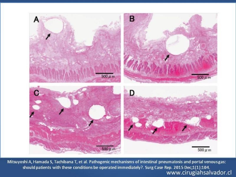 Diapositiva 26 de Neumatosis Intestinal