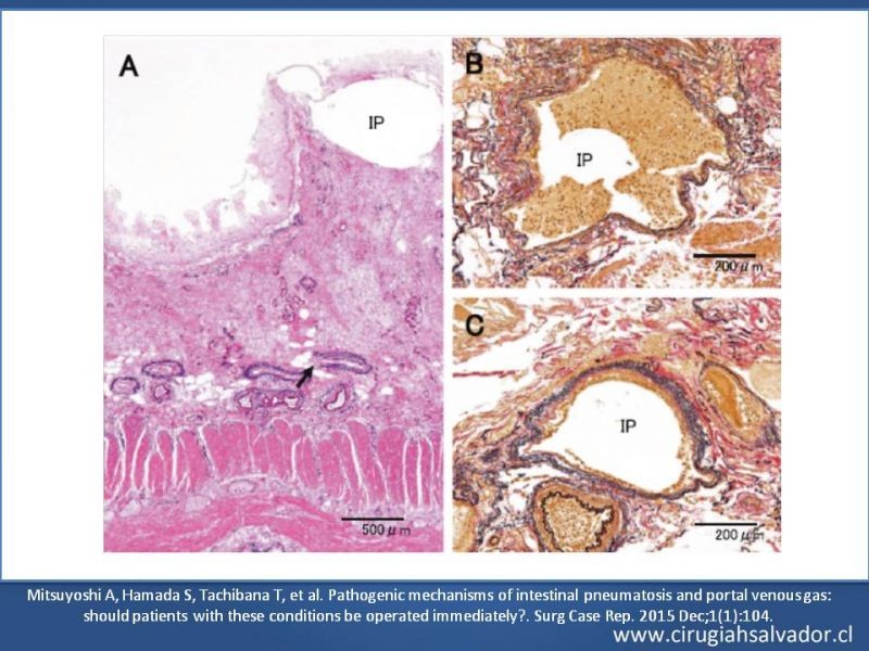 Diapositiva 27 de Neumatosis Intestinal