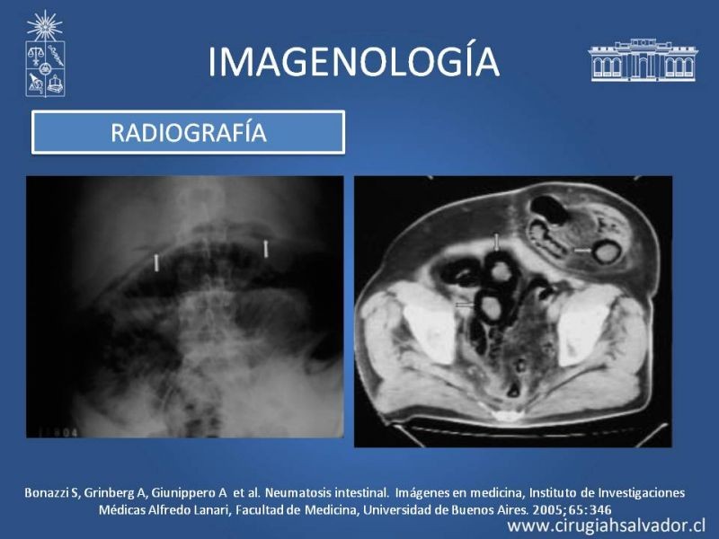 Diapositiva 5 de Neumatosis Intestinal