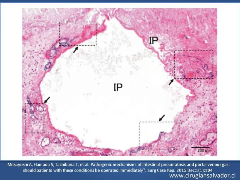 Diapositiva 28 de Neumatosis Intestinal