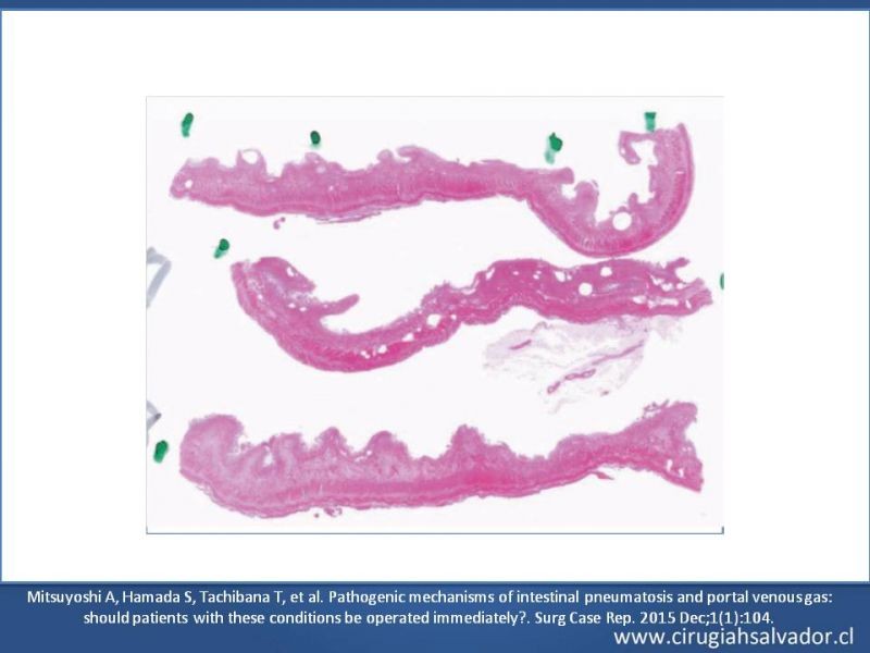 Diapositiva 22 de Neumatosis Intestinal