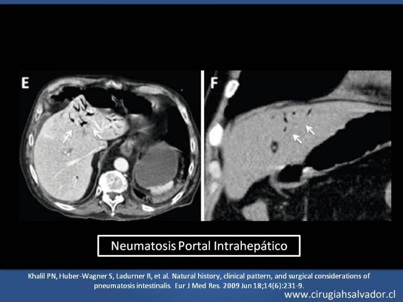 Diapositiva 20 de Neumatosis Intestinal