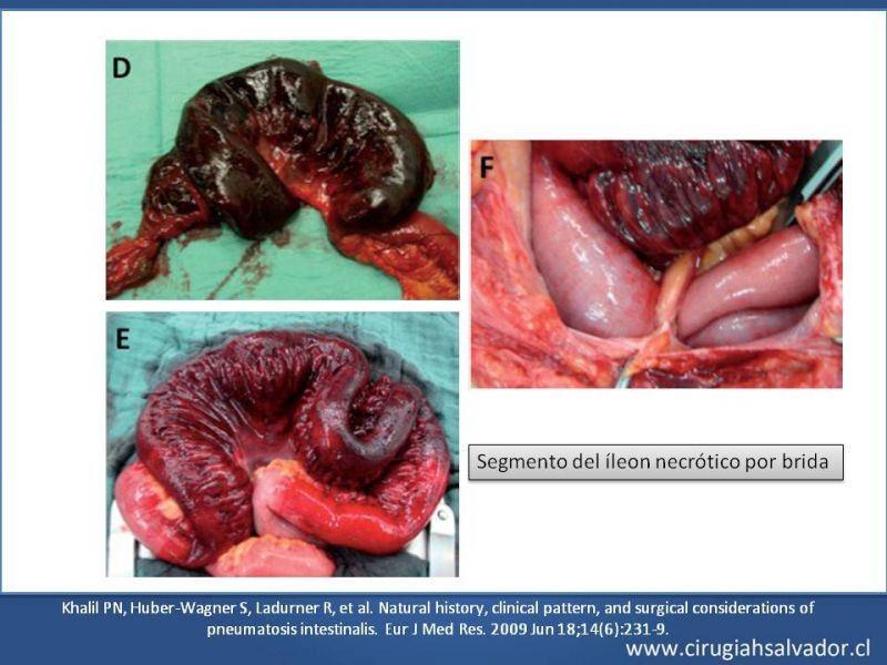 Diapositiva 17 de Neumatosis Intestinal