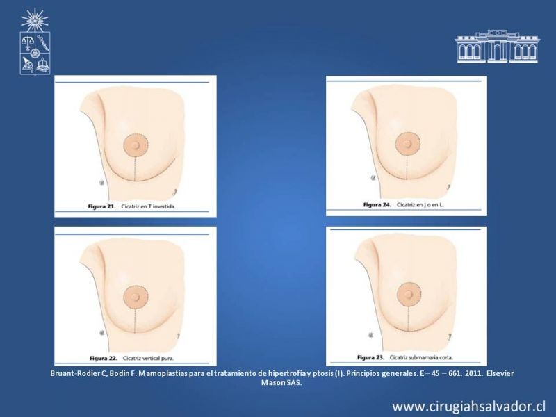 Diapositiva 11 de Reducción Mamaria