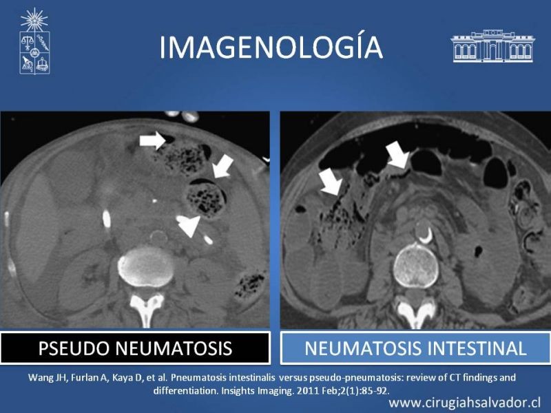 Diapositiva 8 de Neumatosis Intestinal