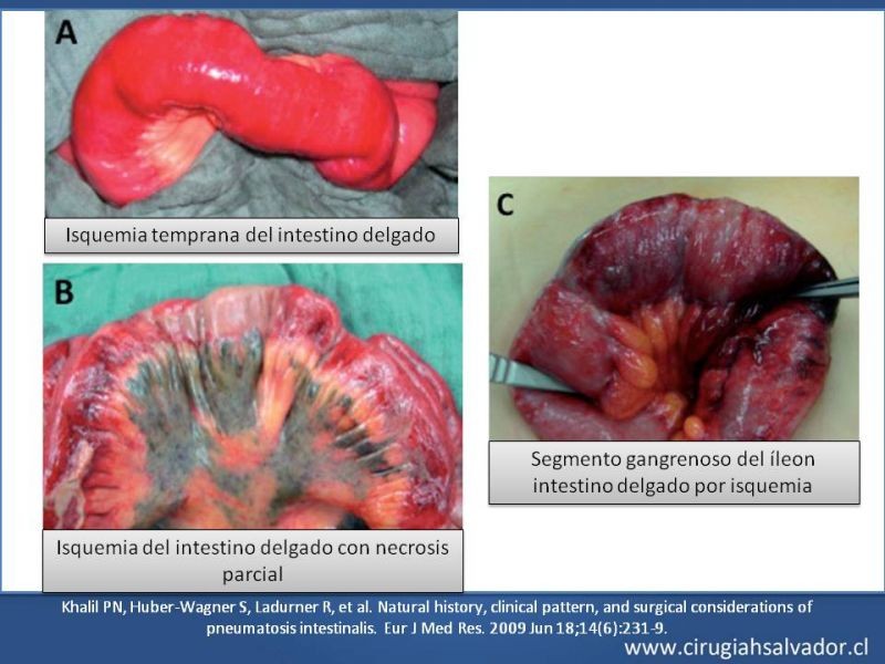 Diapositiva 16 de Neumatosis Intestinal