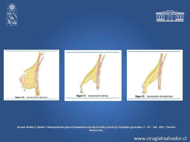 Diapositiva 8 de Reducción Mamaria