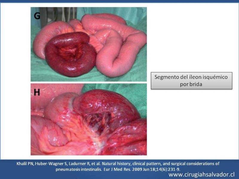 Diapositiva 18 de Neumatosis Intestinal