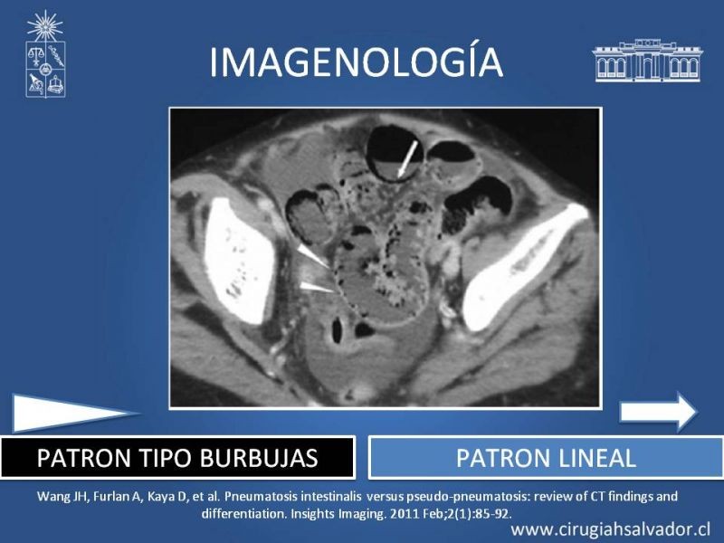 Diapositiva 9 de Neumatosis Intestinal