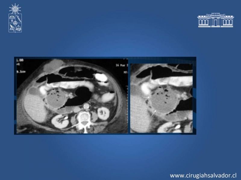 Diapositiva 12 de Ileo postquirúrgico