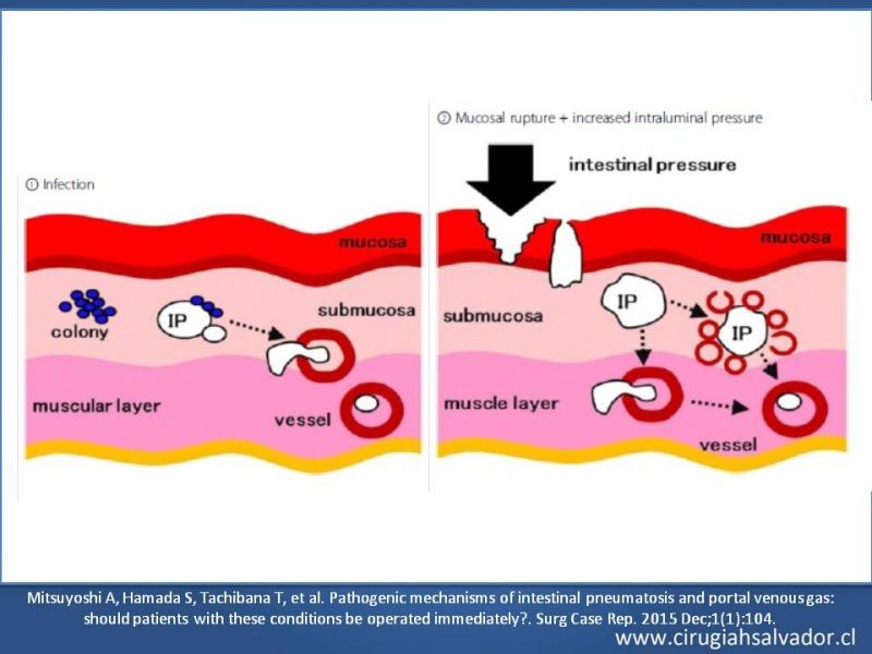 Diapositiva 29 de Neumatosis Intestinal