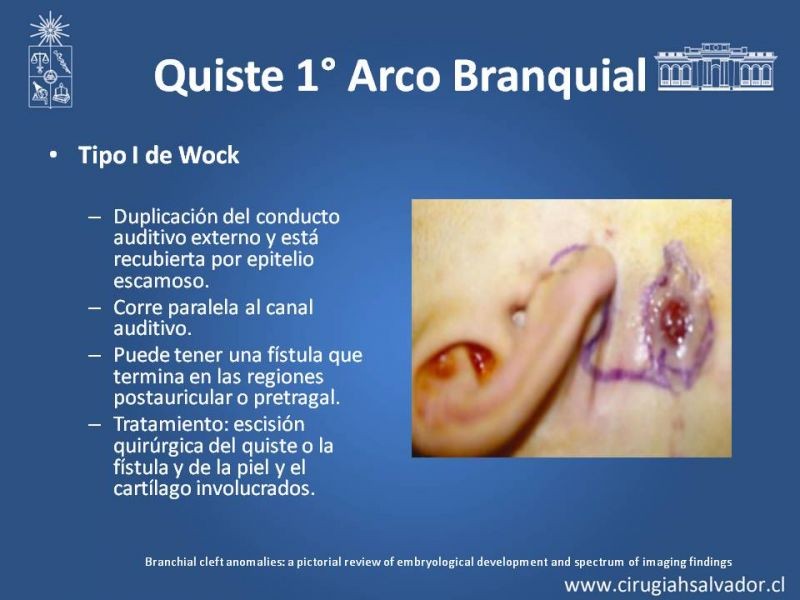 Diapositiva 6 de Quistes Branquiales