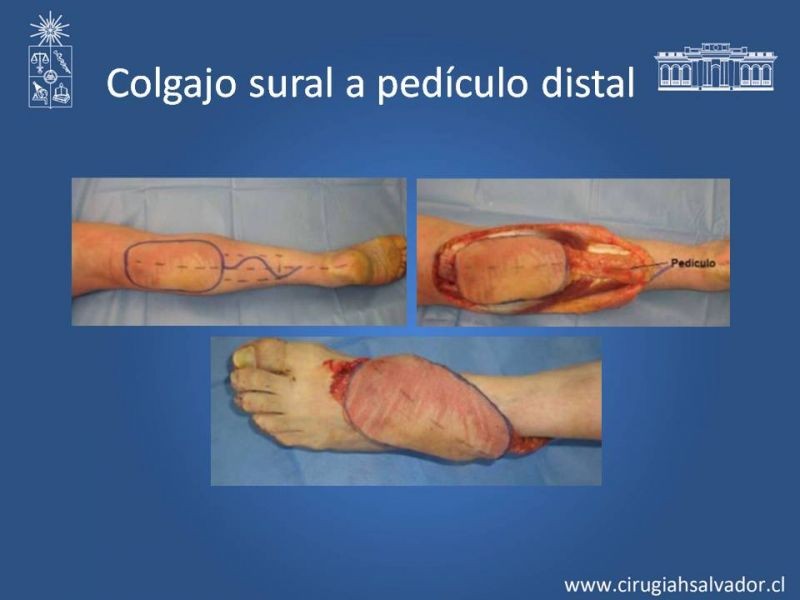 Diapositiva 34 de Reconstrucción de extremidad inferior