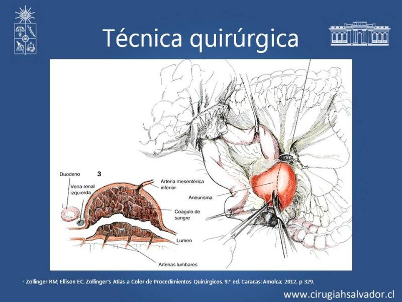 Diapositiva 16 de Aneurisma aórtico abdominal roto