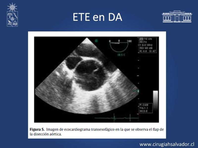 Diapositiva 25 de Síndrome Aórtico Agudo