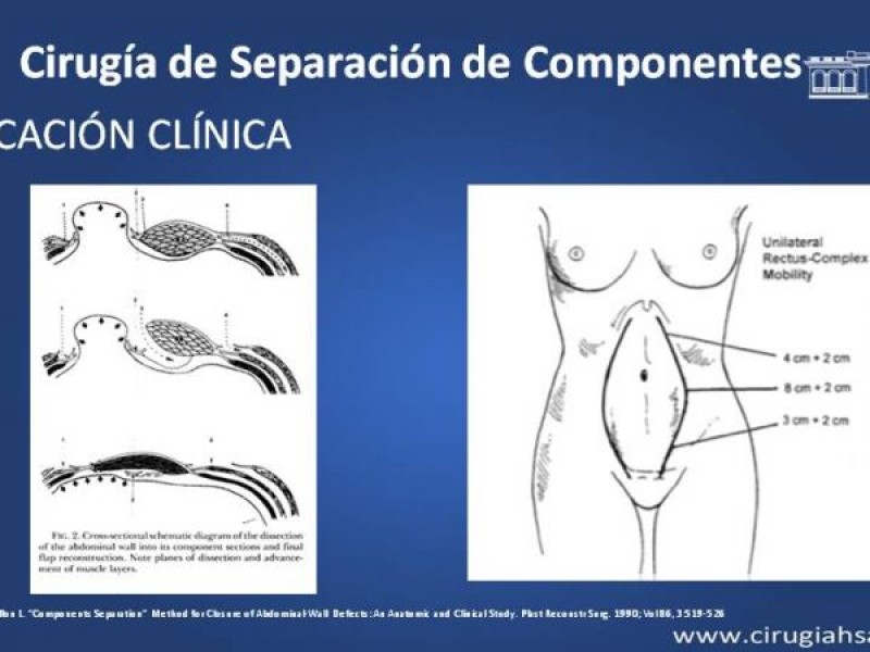 Diapositiva 12 de Cirugía de Separación de Componentes