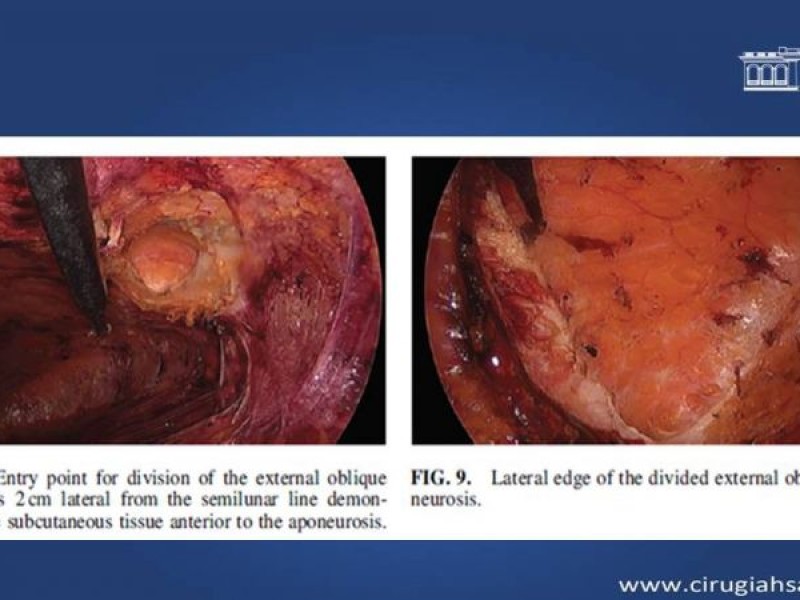 Diapositiva 33 de Cirugía de Separación de Componentes