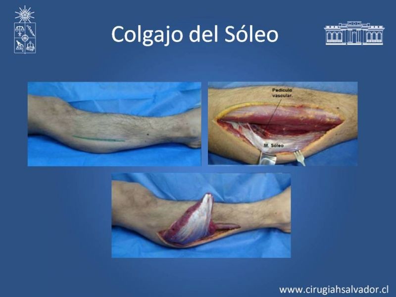 Diapositiva 28 de Reconstrucción de extremidad inferior